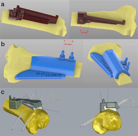 Tibial Tubercle Osteotomy Accuracy How Can We Improve Rush