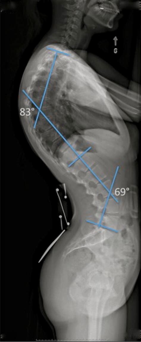 Kyphosis | Posturetek - Subluxation remodeling systems