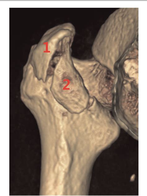 Figure 6 From A Sophisticated Fracture Classification System Of The