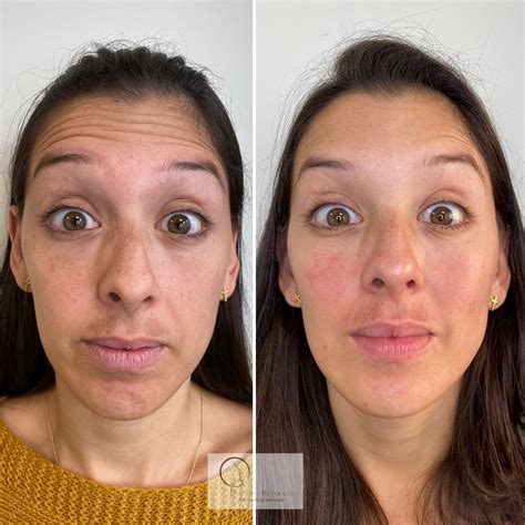 Botox Facial Antes Y Despues Costauniverso The Best Porn Website