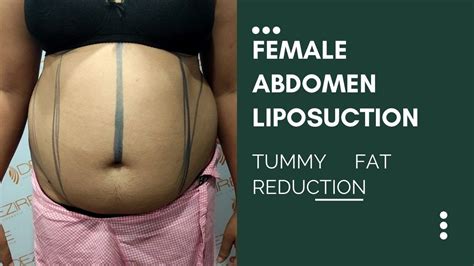 Female Abdomen Liposuction Youtube