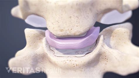 Discos Intervertebrales Spine Health