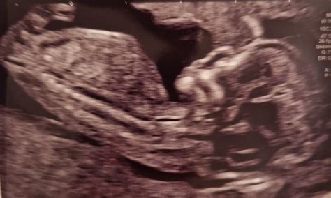 12 Week Scan Guess My Babys Sex Mumsnet