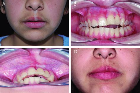 Vermilion Border Lip