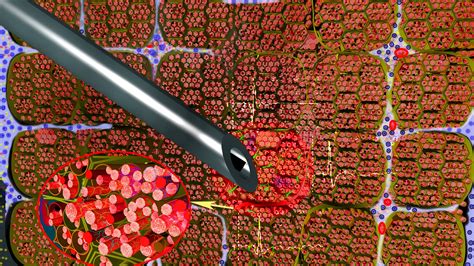 Клиника НМБ | Электронейромиография