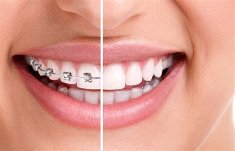 Invisalign Vs Braces Which Is Better For You The Stylus