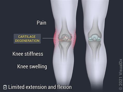 ayman osteoarthritis patient education   osteoarthritis