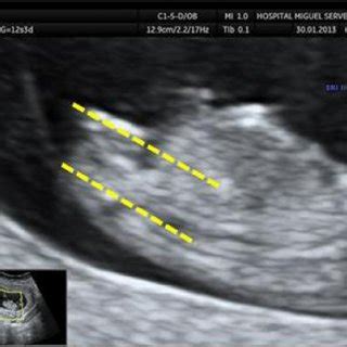 Female Sex Ultrasound Identification Of The Female Fetal Sex At First