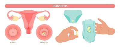 Douche Vagina Odor Clean Blood Flora Ectopic Yeast Bacterial Adesivos Para A Parede V Rus