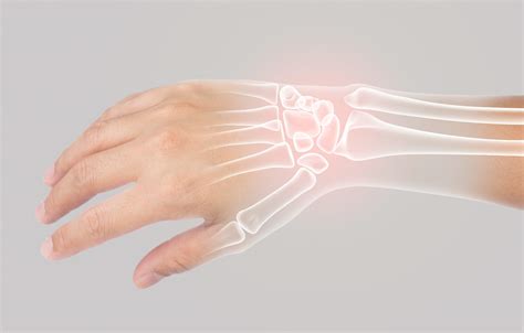 Wrist Fracture – Katranji Hand Center