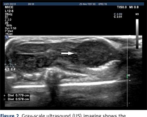 Figure From A Nude Mouse Model Of Orthotopic Liver Transplantation Of Human Hepatocellular