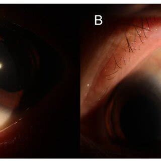 Postoperative Slit Lamp Photography Of The Left Eye Of A Patient The