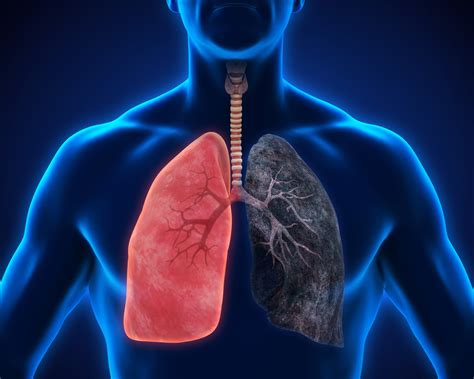Tudo sobre Enfisema Pulmonar: Sintomas, Diagnóstico e Tratamento