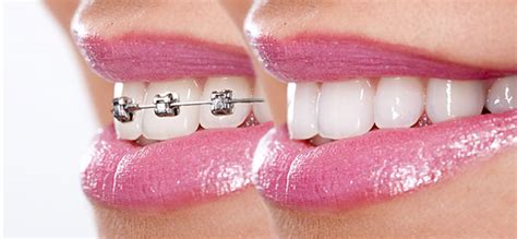 How Braces Work In 5 Simple Steps