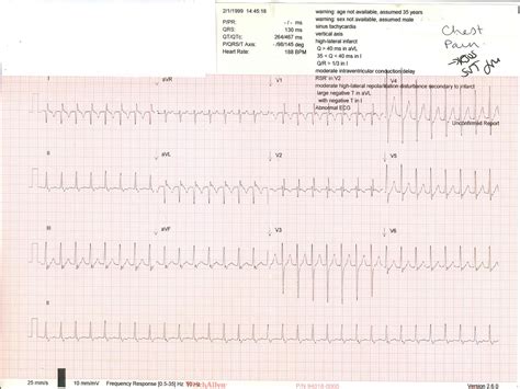 Cardioversion Of A Supraventricular Tachycardia Svt In A 7 Year Old Using A Postural