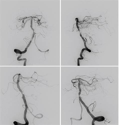 basilar artery occlusion clinical management therapy