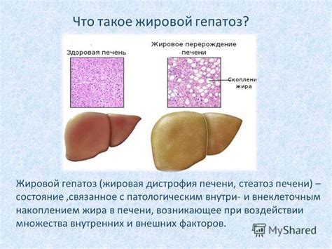 Презентация на тему: "Жировой гепатоз – болезнь или следствие наших ...