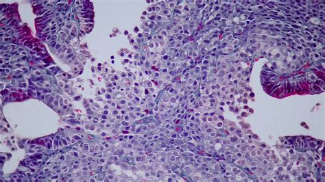 019 Gastric Signet Ring Cell Carcinoma Hea50 Stain Hd Youtube