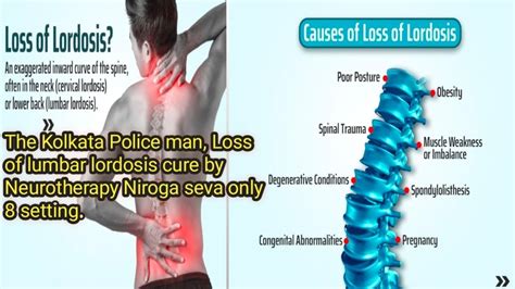 The Kolkata Police Man Loss Of Lumbar Lordosis Cure By Neurotherapy