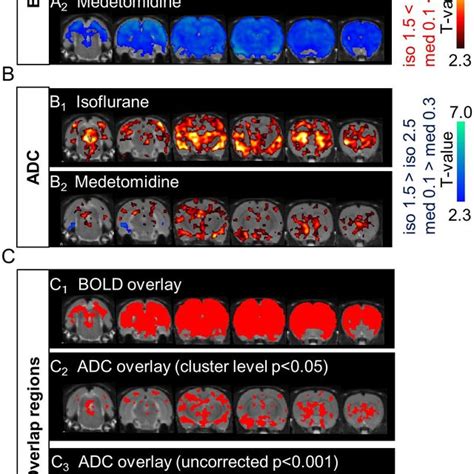 Comparison Of Apparent Diffusion Coefficient ADC And Blood