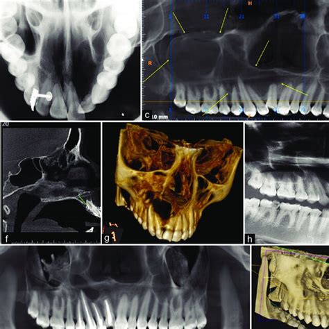 A Pre Operative Clinical Picture Showing Displaced Teeth B