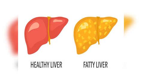 Fatty Liver Disease Symptoms Frequent Nosebleed Is A Warning Sign Of