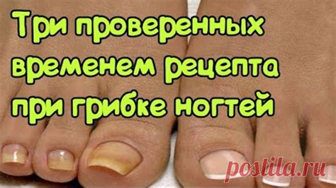 Три проверенных временем рецепта при грибке ногтей | ЛЕЧЕНИЕ | Постила
