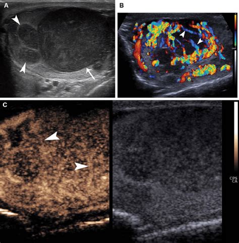 Images From A 74 Year Old Man With Histologically Proven Recurrent