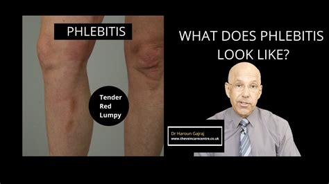 What Cause Phlebitis Thrombophlebitis Causes Symptoms And Risk