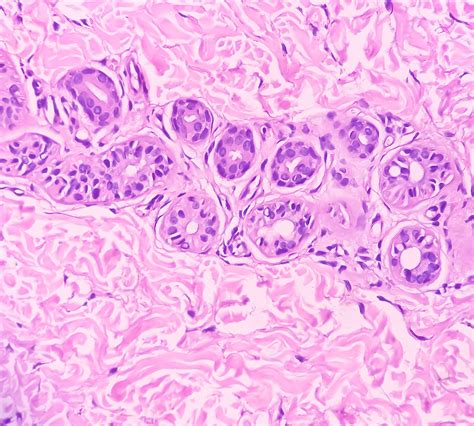 Nemolizumab Granted FDA Approval For Adults Living With Prurigo Nodularis