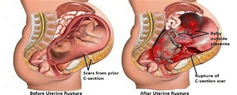 Ruptur Uteri Rahim Robek Saat Melahirkan Serta Cara Penanganannya