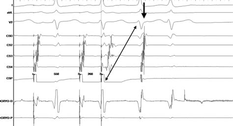 Surface Electrocardiogram ECG And Intra Cardiac Electrogram IECG