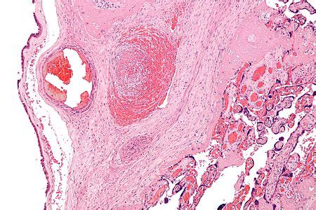 Fetal Thrombotic Vasculopathy Libre Pathology