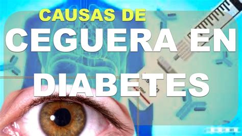 Pérdida de visión en Diabéticos Ceguera en Diabetes Mellitus Causas