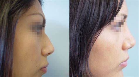 Rhinoplasty Nose Sculpting Photos Before And After Galleries