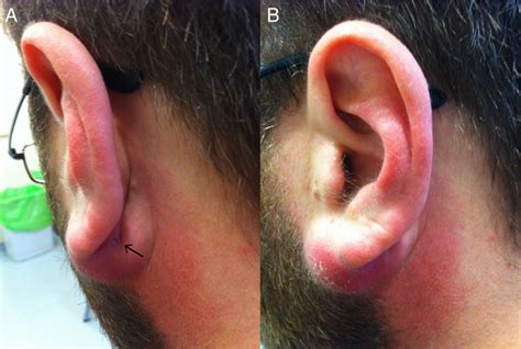 Earlobe Abscess