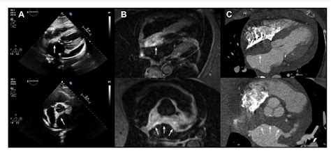 Figure 2 From Lipomatous Hypertrophy Of The Interatrial Septum