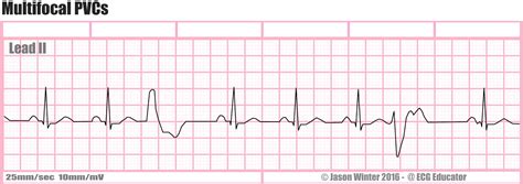 Ecg Educator Blog Six Second Ecg Rhythm Strips