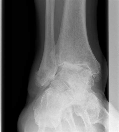 Aquired Adult Flatfoot Deformity The Bone School