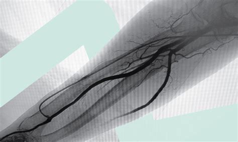 Whats New In Transradial Access European Medical Journal