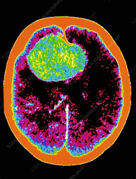 Ct Scan Brain Haemorrhage From Cerebral Aneurysm Stock Image M136