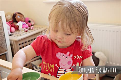 Chicken Pox Has Hit! | K Elizabeth