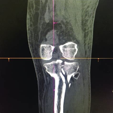 (PDF) Multi-detector computed tomographic evaluation of tibial plateau ...