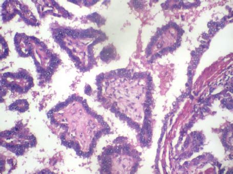 Section showing papillae lined by follicular cells exhibiting optical... | Download Scientific ...