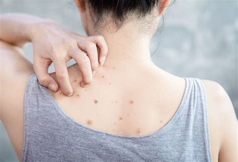 Back Acne - Causes, Types & Effective Treatments | Premier Clinic