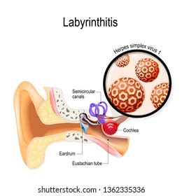 Labyrinthitis Vestibular Neuritis Inflammation Inner Ear Stock