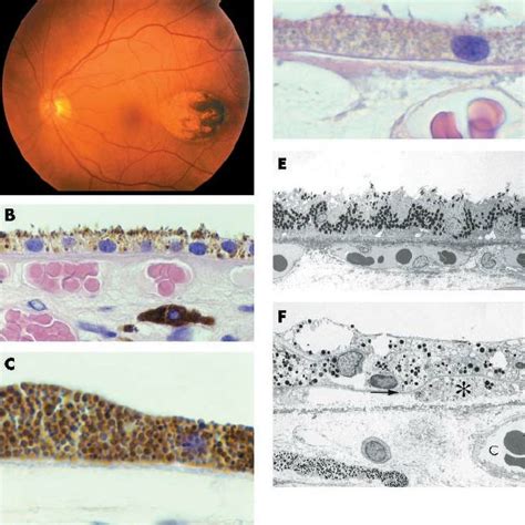A 24 Year Old Patient Developed Herpes Zoster Ophthalmicus After Using