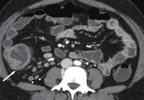 A 26 Year Old Female Patient Proven Case Of Abdominal Tuberculosis