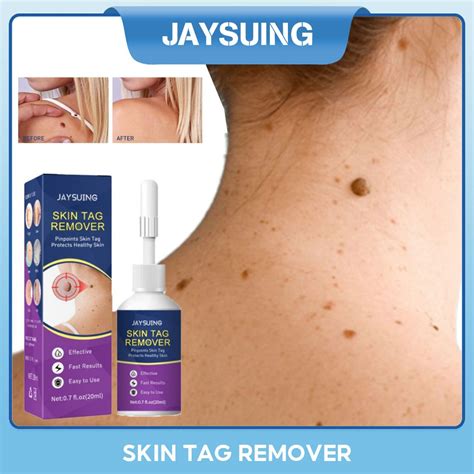 Jaysuing Skin Tag Remover 20ml Warts Removal Drop Painless Eliminate