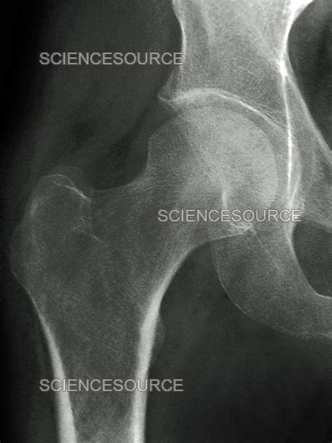 normal hip  ray stock image science source images